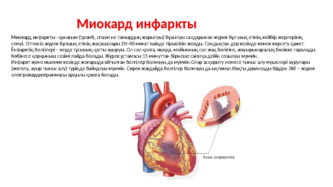 Миокард инфаркты ­– қанағым (тромб, спазм не тамырдың жарылуы) бұзылуы салдарынан жүрек бұл шық етінің кейбір жерлерінің семуі.