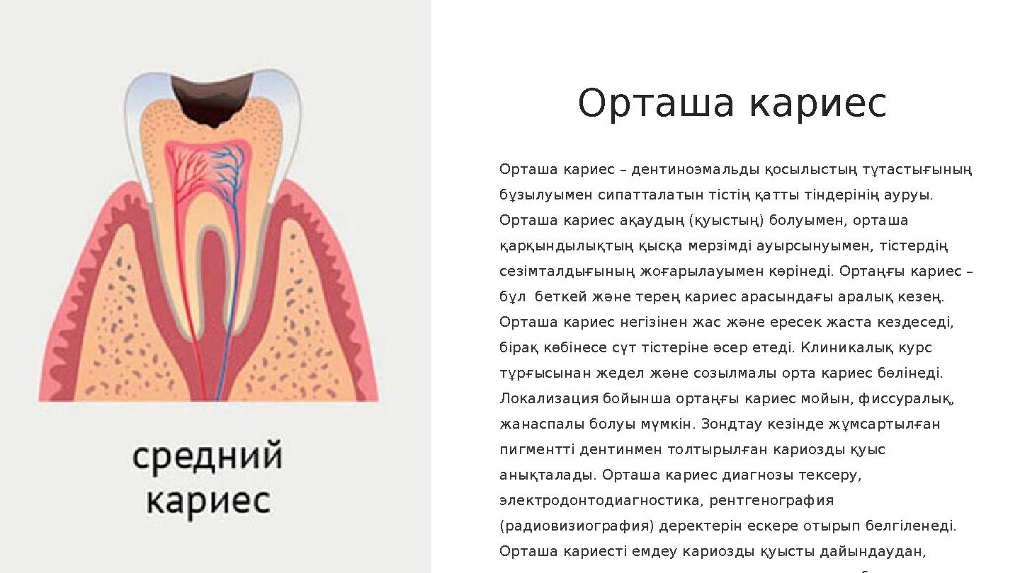 Орташа кариес Орташа кариес – дентиноэмальды қосылыстың тұтастығының бұзылуымен сипатталатын тістің қатты тіндерінің ауруы. Ор