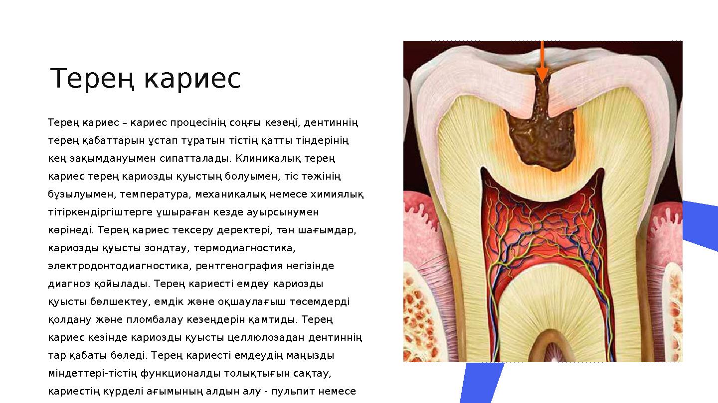 Терең кариес Терең кариес – кариес процесінің соңғы кезеңі, дентиннің терең қабаттарын ұстап тұратын тістің қатты тіндерінің к