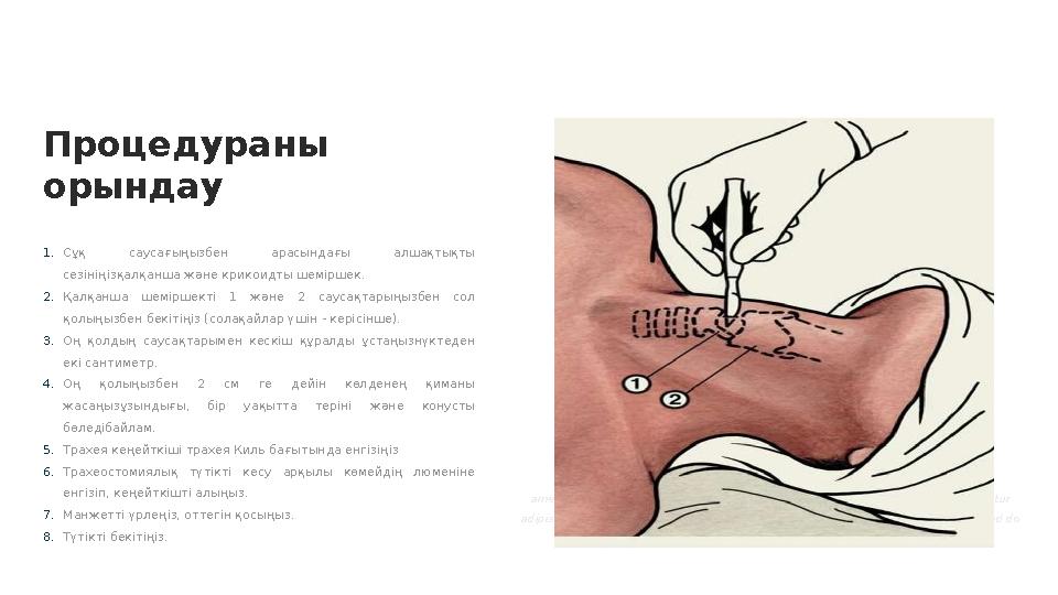 Процедураны орындау 1. Сұқ саусағыңызбен арасындағы алшақтықты сезініңізқалқанша және крикоидты шеміршек. 2. Қалқанша шемі