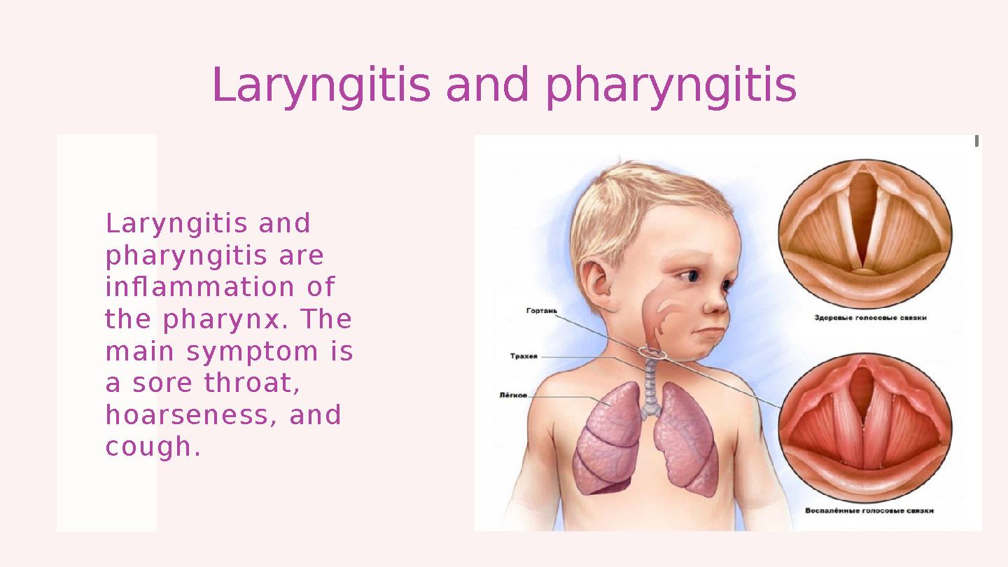 Laryngitis and pharyngitis L ary n gitis an d ph ary n gitis are infl am m atio n of th e ph ary n x . T h e m ain