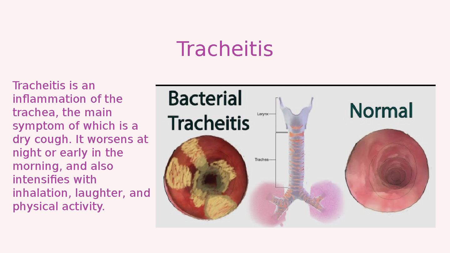 Tracheitis is an inflammation of the trachea, the main symptom of which is a dry cough. It worsens at night or early in the