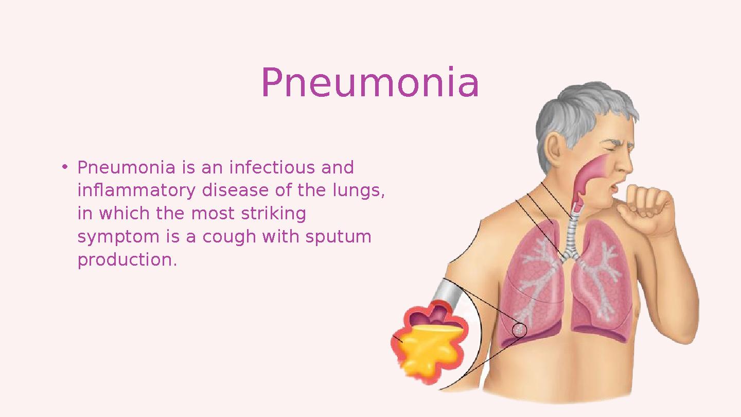 • Pneumonia is an infectious and inflammatory disease of the lungs, in which the most striking symptom is a cough with sputum