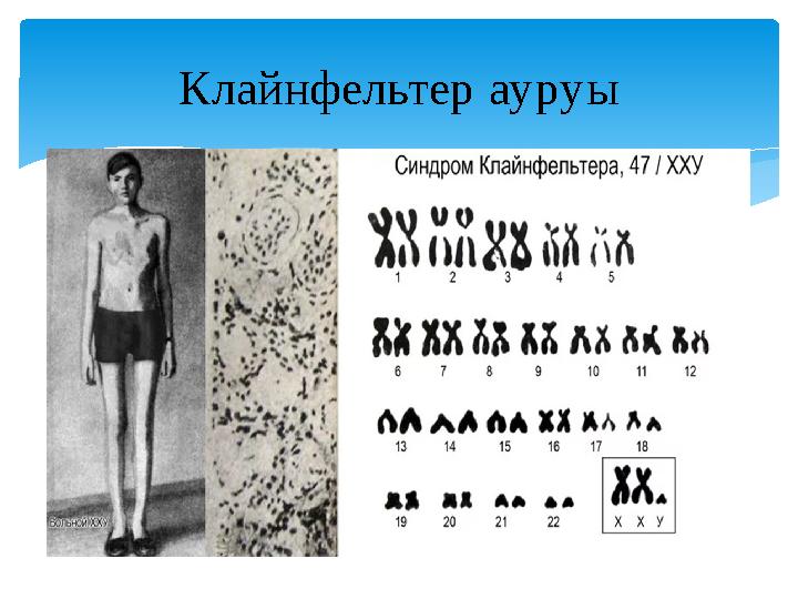 Клайнфельтер ауруы