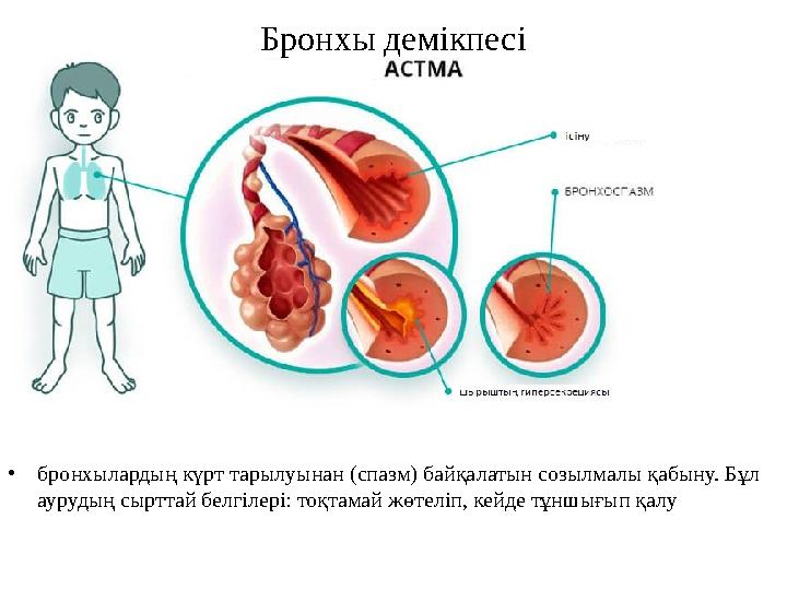 Бронхы демікпесі •бронхылардың күрт тарылуынан (спазм) байқалатын созылмалы қабыну. Бұл аурудың сырттай белгілері: тоқтамай жөт