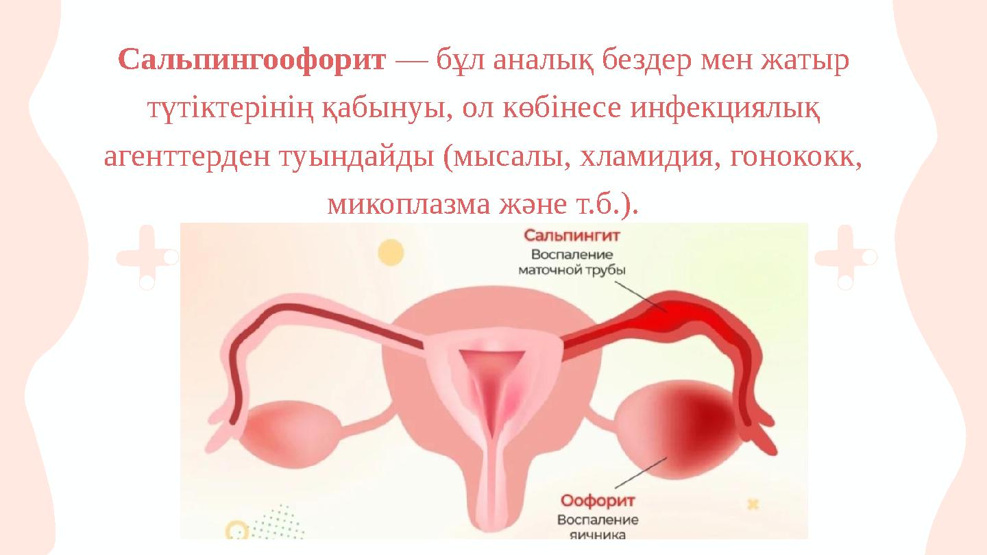 Сальпингоофорит — бұл аналық бездер мен жатыр түтіктерінің қабынуы, ол көбінесе инфекциялық агенттерден туындайды (мысалы, хла