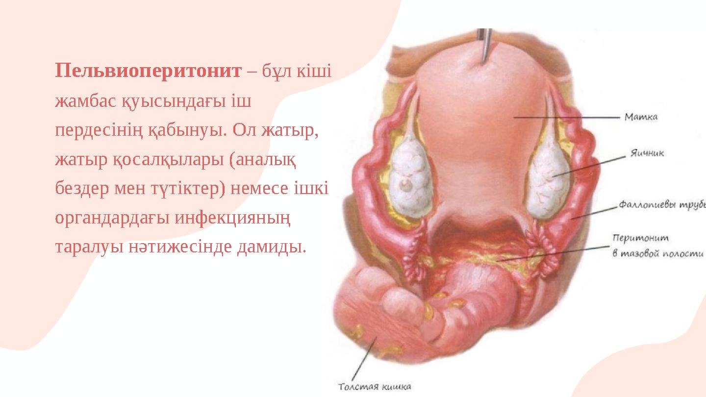 Пельвиоперитонит – бұл кіші жамбас қуысындағы іш пердесінің қабынуы. Ол жатыр, жатыр қосалқылары (аналық бездер мен түтіктер