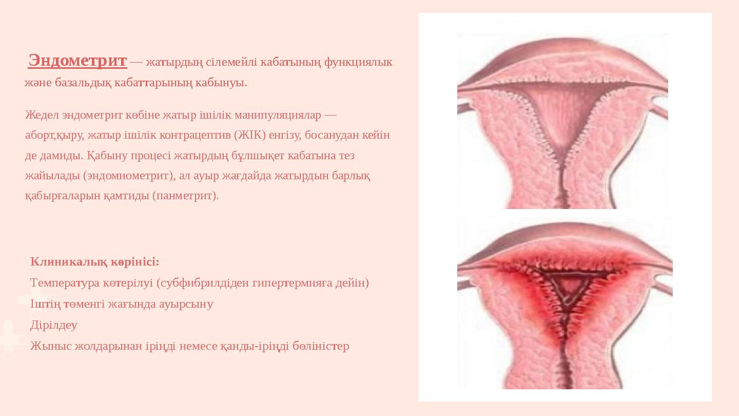 Жедел эндометрит көбіне жатыр ішілік манипуляциялар — аборт,қыру, жатыр ішілік контрацептив (ЖІК) енгізу, босанудан кейін де д