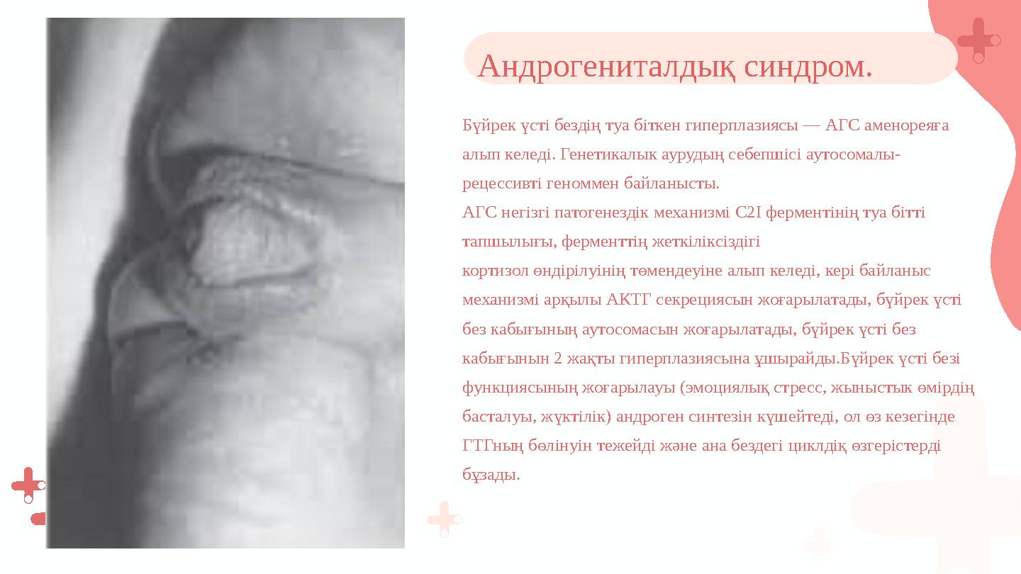 Бүйрек үсті бездің туа біткен гиперплазиясы — АГС аменореяға алып келеді. Генетикалык аурудың себепшісі аутосомалы- рецессивті