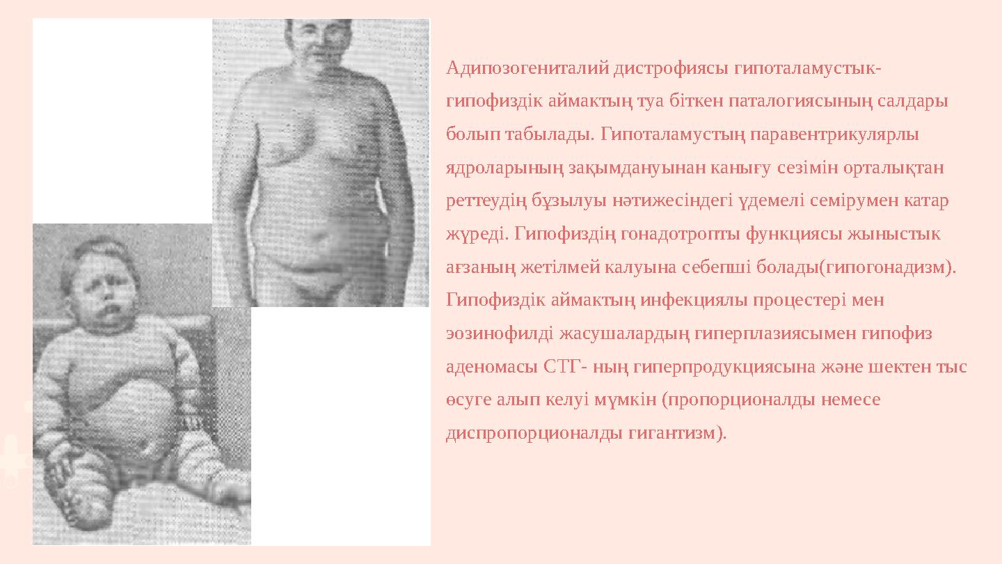 Адипозогениталий дистрофиясы гипоталамустык- гипофиздік аймактың туа біткен паталогиясының салдары болып табылады. Гипоталамуст