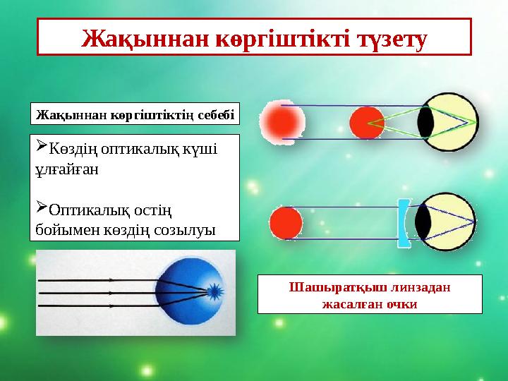 Жақыннан көргіштікті түзету Жақыннан көргіштіктің себебі Көздің оптикалық күші ұлғайған Оптикалық остің бойымен көздің соз