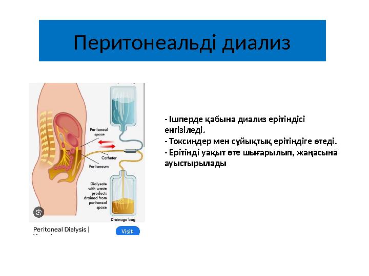 Перитонеальді диализ - Ішперде қабына диализ ерітіндісі енгізіледі. - Токсиндер мен сұйықтық ерітіндіге өтеді. - Ерітінді уақ