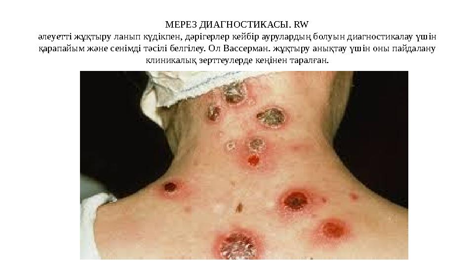 МЕРЕЗ ДИАГНОСТИКАСЫ. RW әлеуетті жұқтыру ланып күдікпен, дәрігерлер кейбір аурулардың болуын диагностикалау үшін қарапайым және