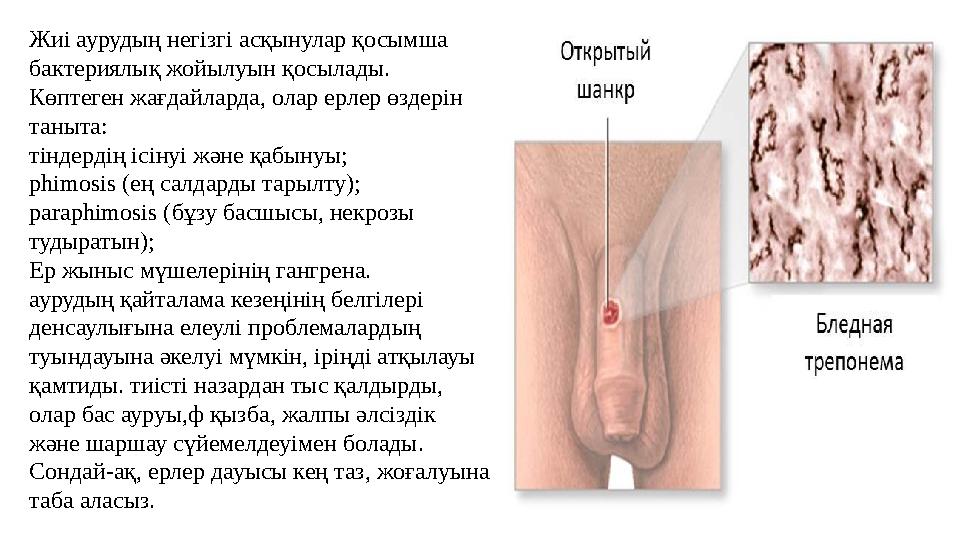 Жиі аурудың негізгі асқынулар қосымша бактериялық жойылуын қосылады. Көптеген жағдайларда, олар ерлер өздерін таныта: тіндерд