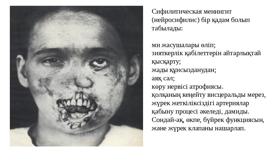 Сифилитическая менингит (нейросифилис) бір қадам болып табылады: ми жасушалары өліп; зияткерлік қабілеттерін айтарлықтай қысқ