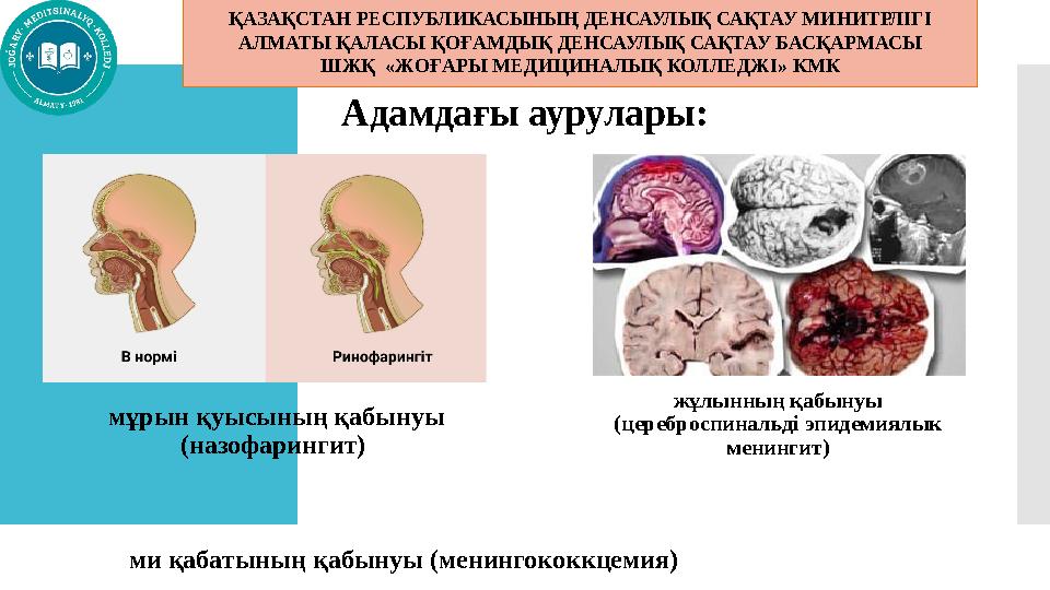 Адамдағы аурулары: мұрын қуысының қабынуы (назофарингит) жұлынның қабынуы (цереброспинальді эпидемиялык менингит) ми қабаты