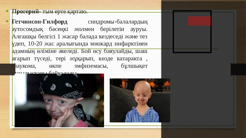 •Прогерий- тым ерте қартаю. •Гетчинсон-Гилфорд синдромы-балалардың аутосомдық бәсеңкі жолмен берілетін ауруы. Алғашқы белгі