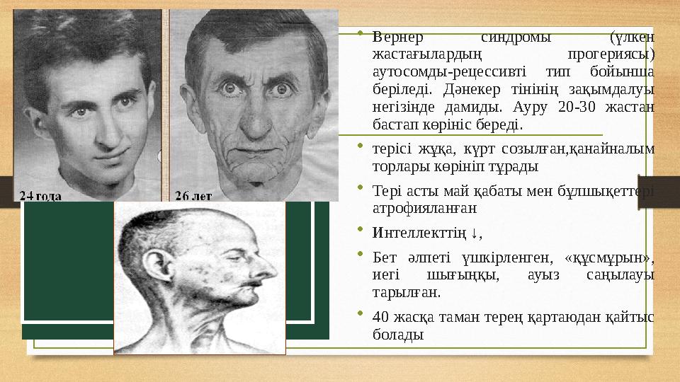 •Вернер синдромы (үлкен жастағылардың прогериясы) аутосомды-рецессивті тип бойынша беріледі. Дәнекер тінінің зақымдалуы негі