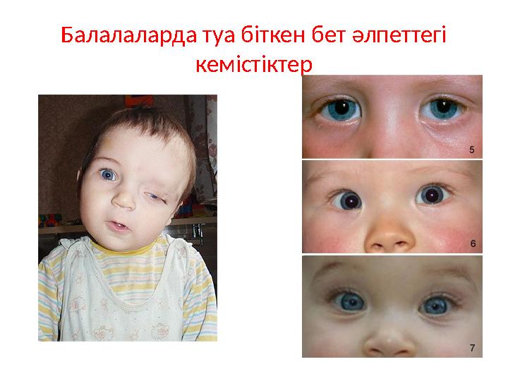 Балалаларда туа біткен бет әлпеттегі кемістіктер