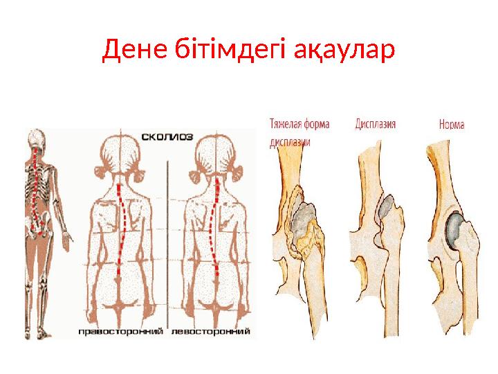 Дене бітімдегі ақаулар