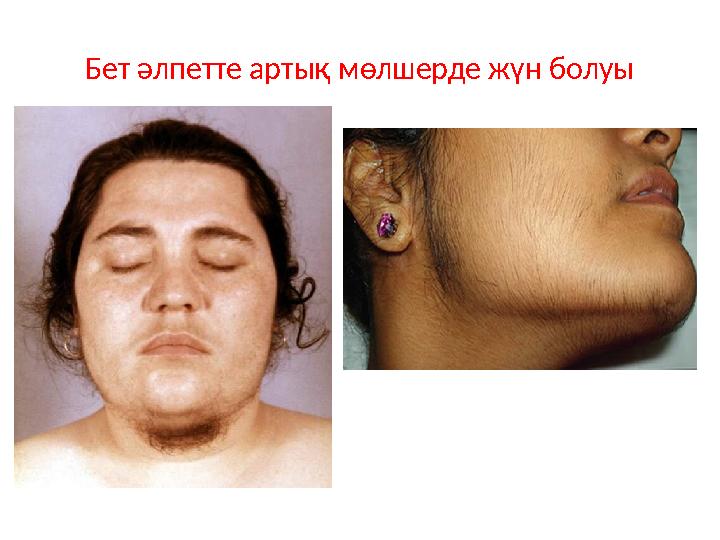 Бет әлпетте артық мөлшерде жүн болуы