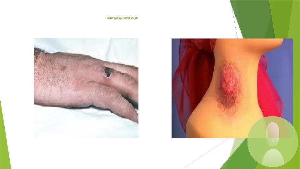 Сыртқы қабат жұқпалары