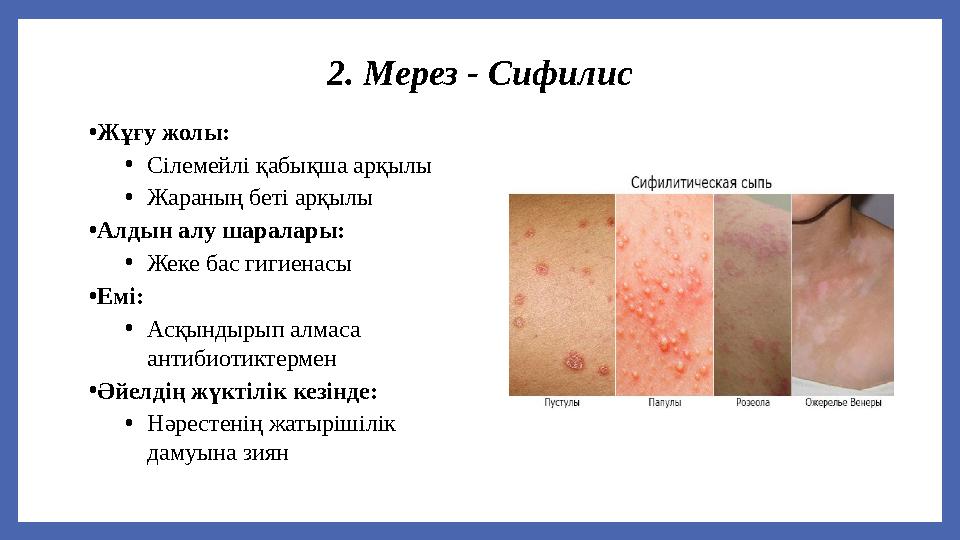 2. Мерез - Сифилис •Жұғу жолы: •Сілемейлі қабықша арқылы •Жараның беті арқылы •Алдын алу шаралары: •Жеке бас гигиенасы •Емі: •Ас